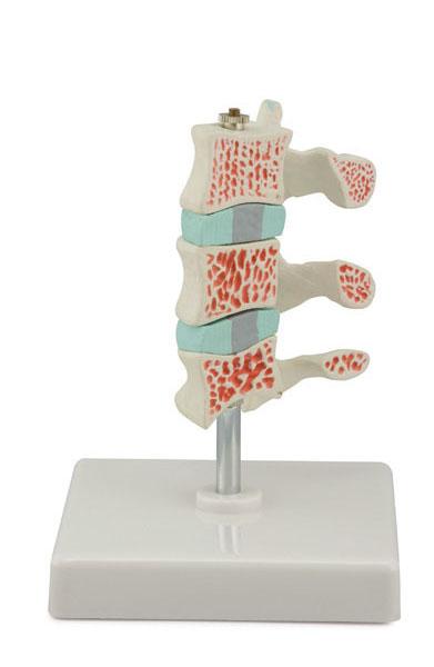 Advanced Osteoporosis Model