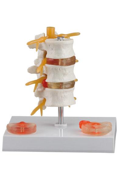 3 Lumbar Vertebrae with Hernia and Prolapsed In vertebral Disc