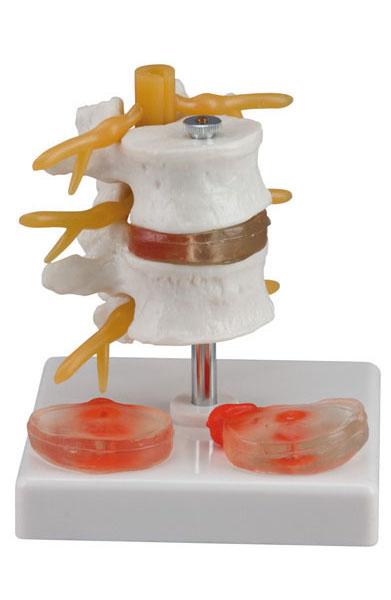 2 Lumbar Vertebrae with Hernia and Prolapsed Invertebral Disc