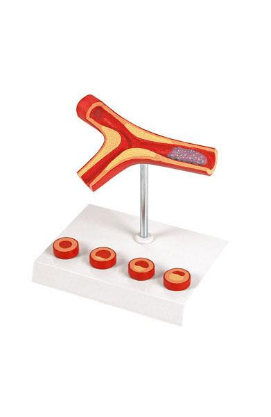 Atherosclerosis and Thrombosis Model