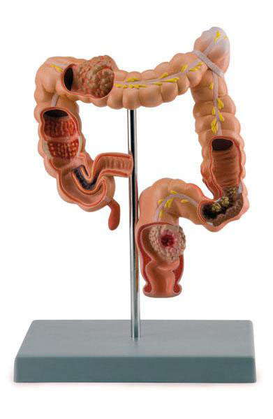 Pathological Model of Colon and Rectum