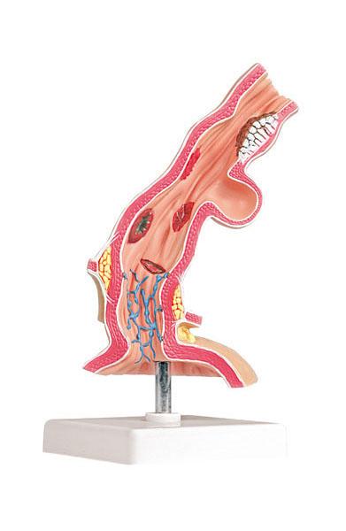 Pathological Model of Esophagus