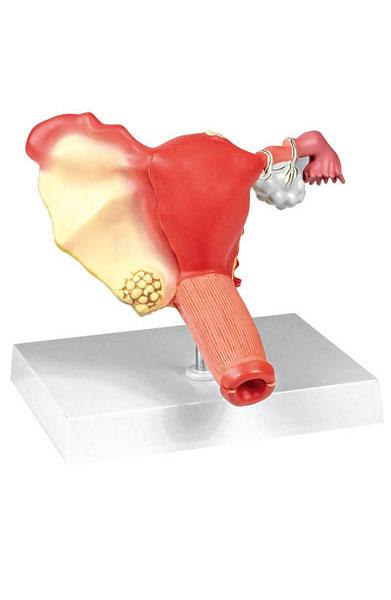 Pathological Model of Female Reproductive System