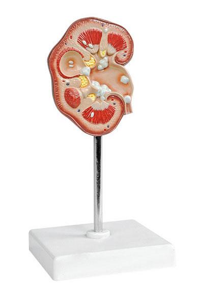 Pathological Model of Renal Calculus