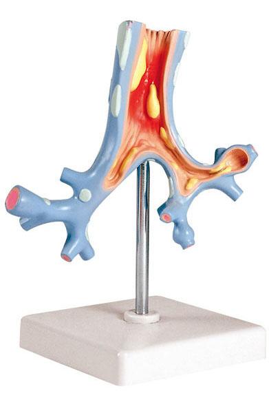 Pathological Model of the Bronchi