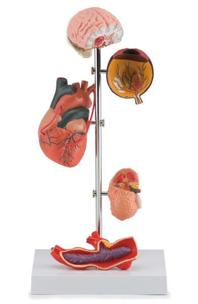 Effects of Hypertension 5 parts